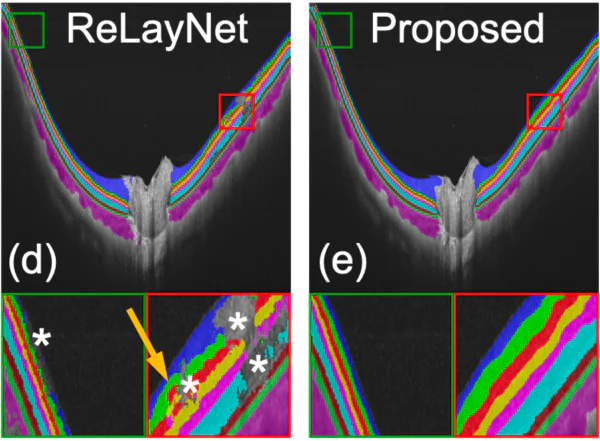 GCN-assisted retinal segmentation paper preview